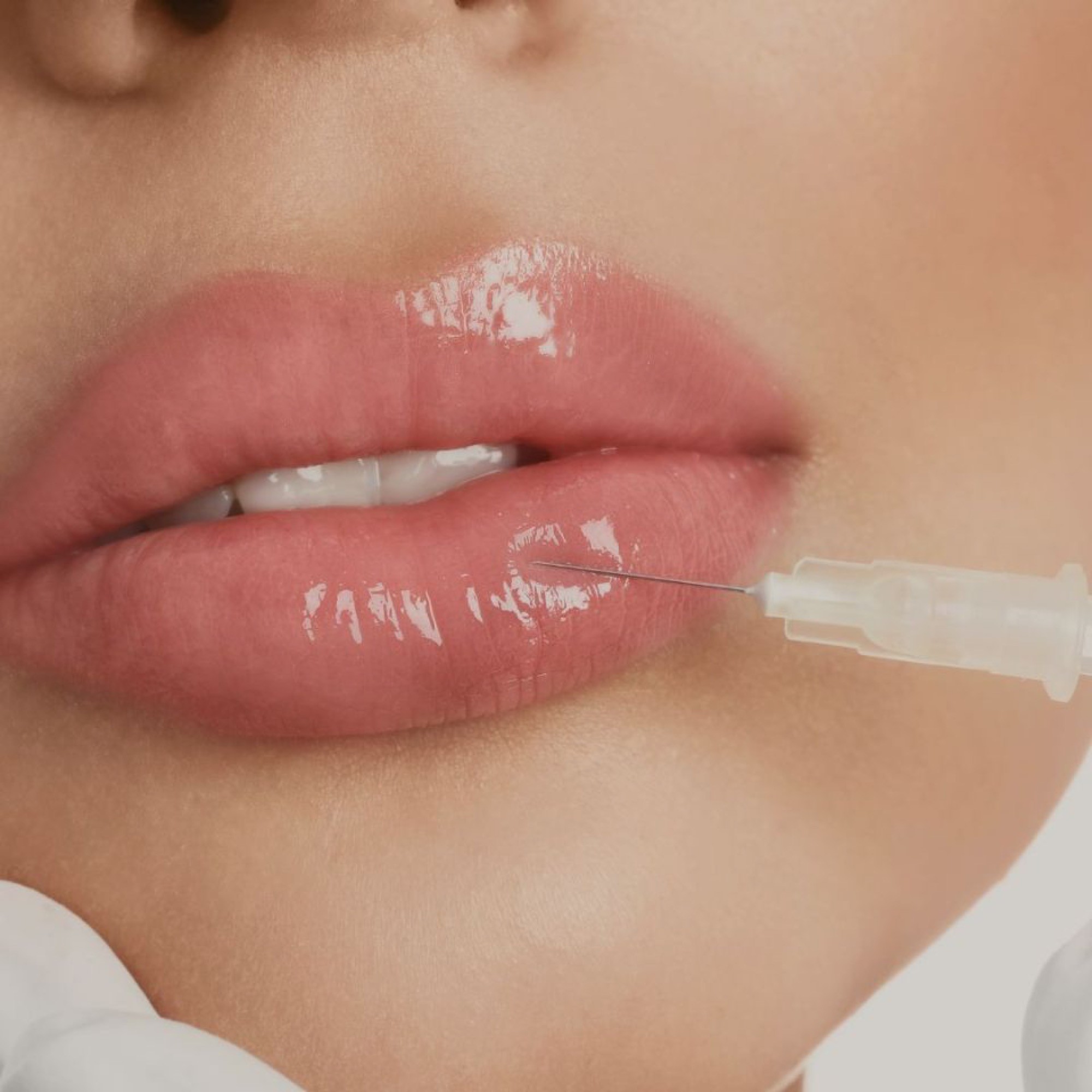 Lippenunterspritzung mit Hyaluron bei Aria Medical Beauty